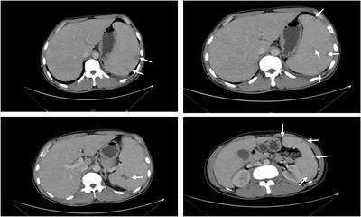 Acute Brucella infection associated with splenic infarction: a case report and review of the literature